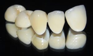 Zahnersatz Veneers